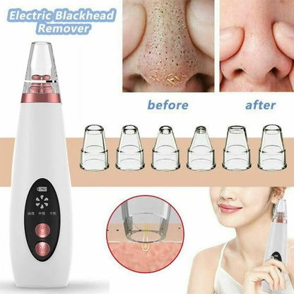 USB Rechargeable Facial Pore Vacuum and Acne Remover - Deep Cleansing Skin Care Tool with Black Dot Cleaner for Pimple Removal