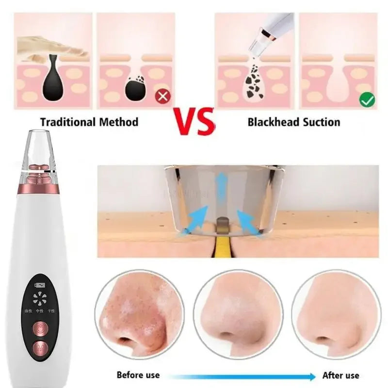 USB Rechargeable Facial Pore Vacuum and Acne Remover - Deep Cleansing Skin Care Tool with Black Dot Cleaner for Pimple Removal